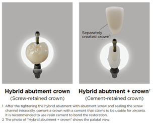 KZ1-implant-faq-02