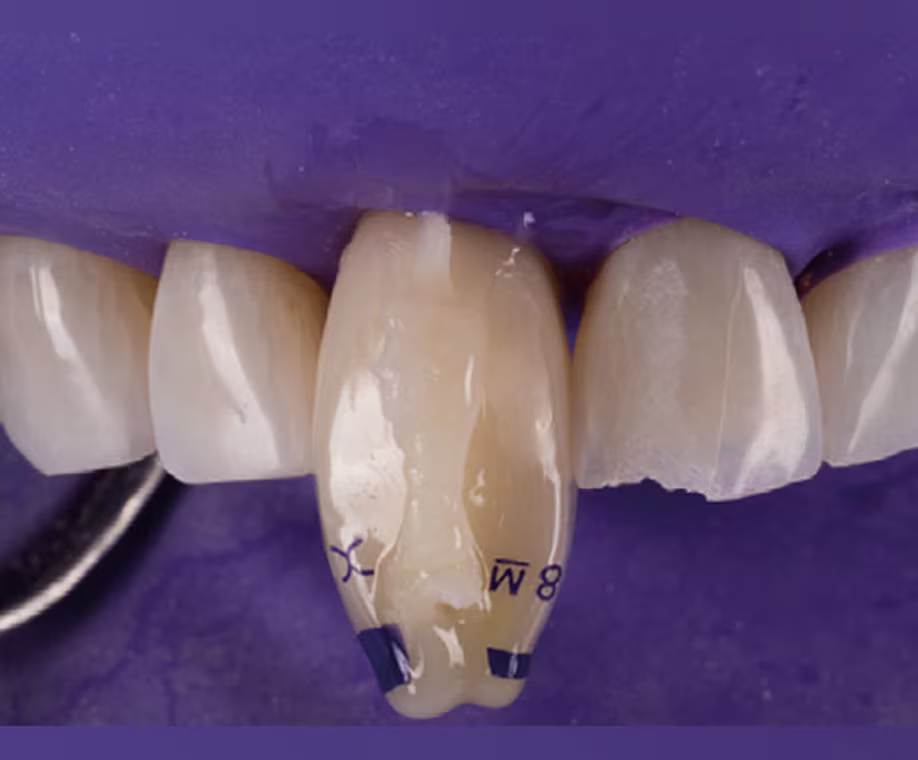 Procedure Conservatively Rejuvenates Maxillary Anterior Dentition