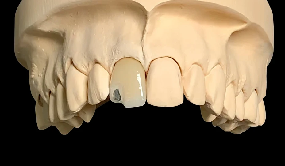 Repair-of-porcelain-chippings-01
