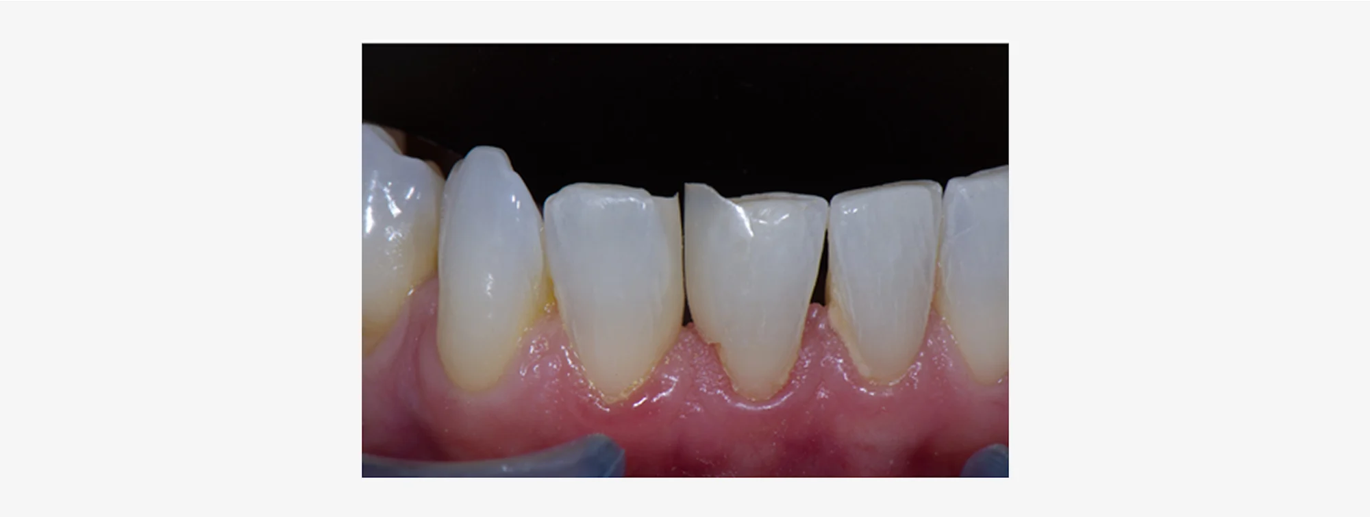 news-article-teeth-1